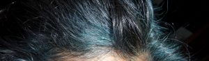 Blue Hairline used to be Grey Hair 