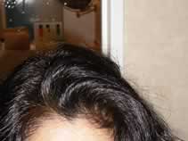 Maryam indigoed hair, upper forehead front view